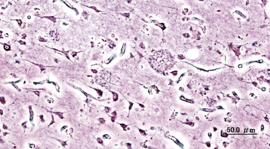 alzheimer-plaque-amyloid-onset