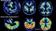 brain-with-alzheimer-without