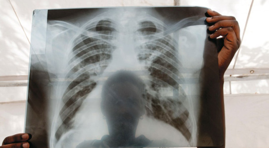 A chest X-ray from a patient with tuberculosis (TB) in Lira, Uganda. Uganda is one of 22 countries accounting for roughly 80% of new TB cases each year. Credit: J. Matthews/Panos