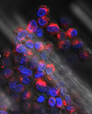 cluster-of-circulating-tumor-cells-from-a-breast-cancer-patient