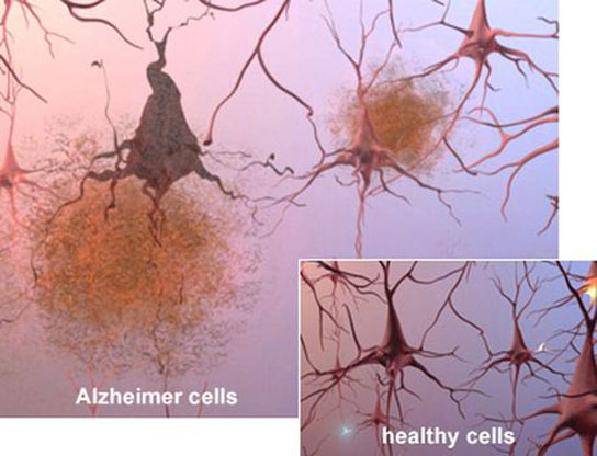 difference-between-healthy-alzheimer-cells