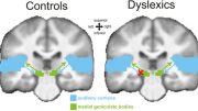 discovered an important neural mechanism underlying dyslexia