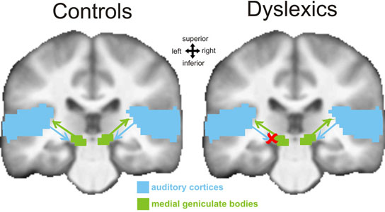 discovered an important neural mechanism underlying dyslexia