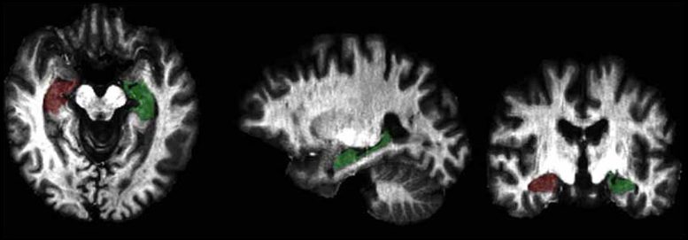 fMRI PTSD Veteran Brain