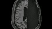 fMRI Scan of Adult with One Brain Hemisphere Removed