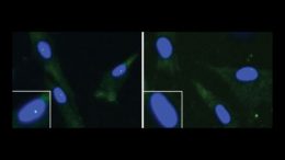 fibroblasts from an unaffected individual (left) and an ALS patient with a FUS mutation