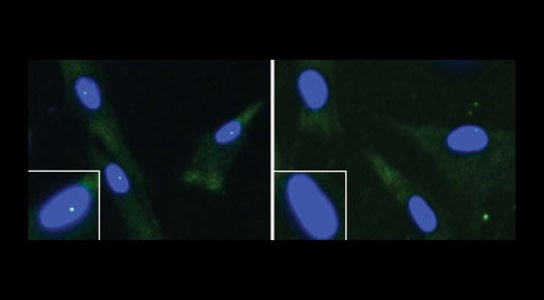 fibroblasts from an unaffected individual (left) and an ALS patient with a FUS mutation