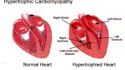 hypertrophic-cardiomyopathy