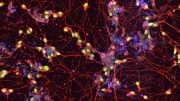 iPSCs Derived Motor Neurons Derived From an ALS Patient