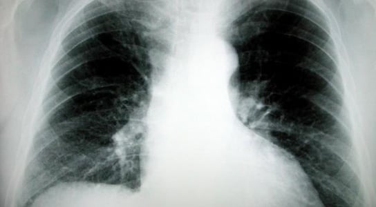 lung-cancer-x-ray