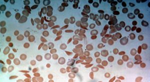 Researchers Use Microfluidic Device to Monitor Sickle Cell Disease