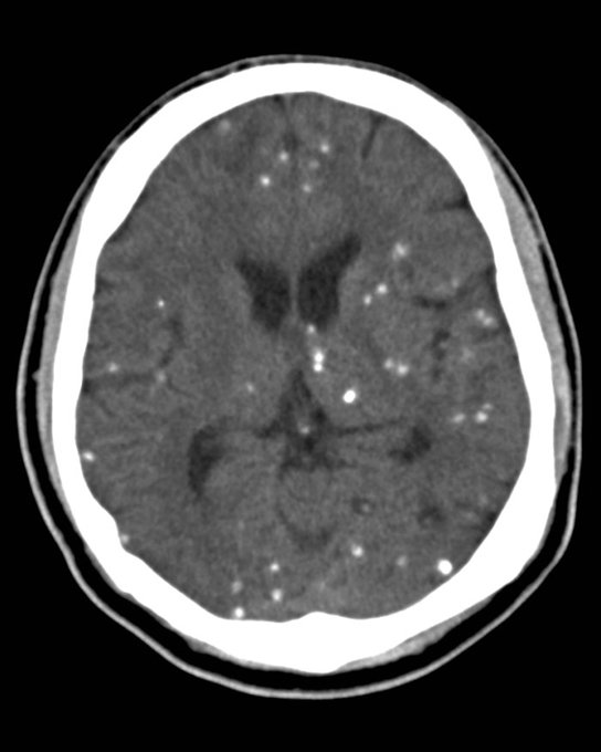 neurocysticercosis-x-ray