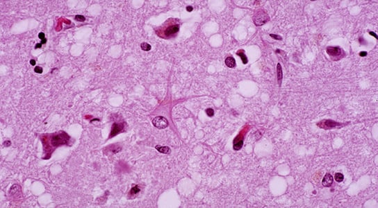 prion-disease