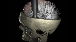 researchers map damaged connections in Phineas Gage's brain