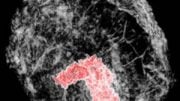 technique images breast tumors in 3-D
